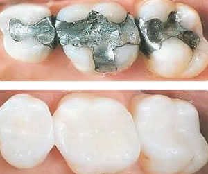 Fractured Tooth Repair  Dental Fillings Colorado Springs CO