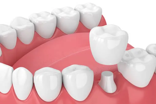 single dental crown